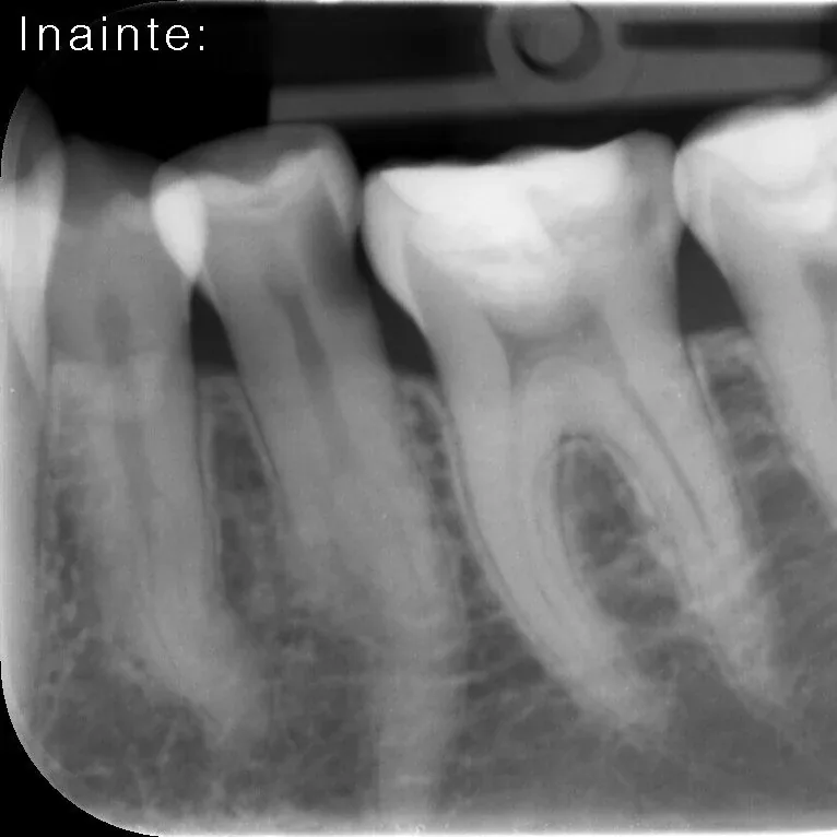 Ilustrație pentru articolul „10 avantaje ale magnificației în endodonție”, imaginea 3