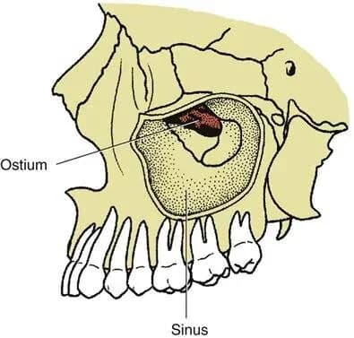 Ilustrație pentru articolul „Dinte în sinus: de ce extracția cere un specialist”, imaginea 2