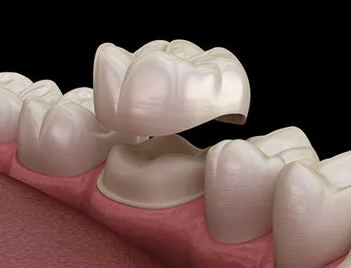 Imagine pentru articolul „Coroane ceramice pe suport de zirconiu”