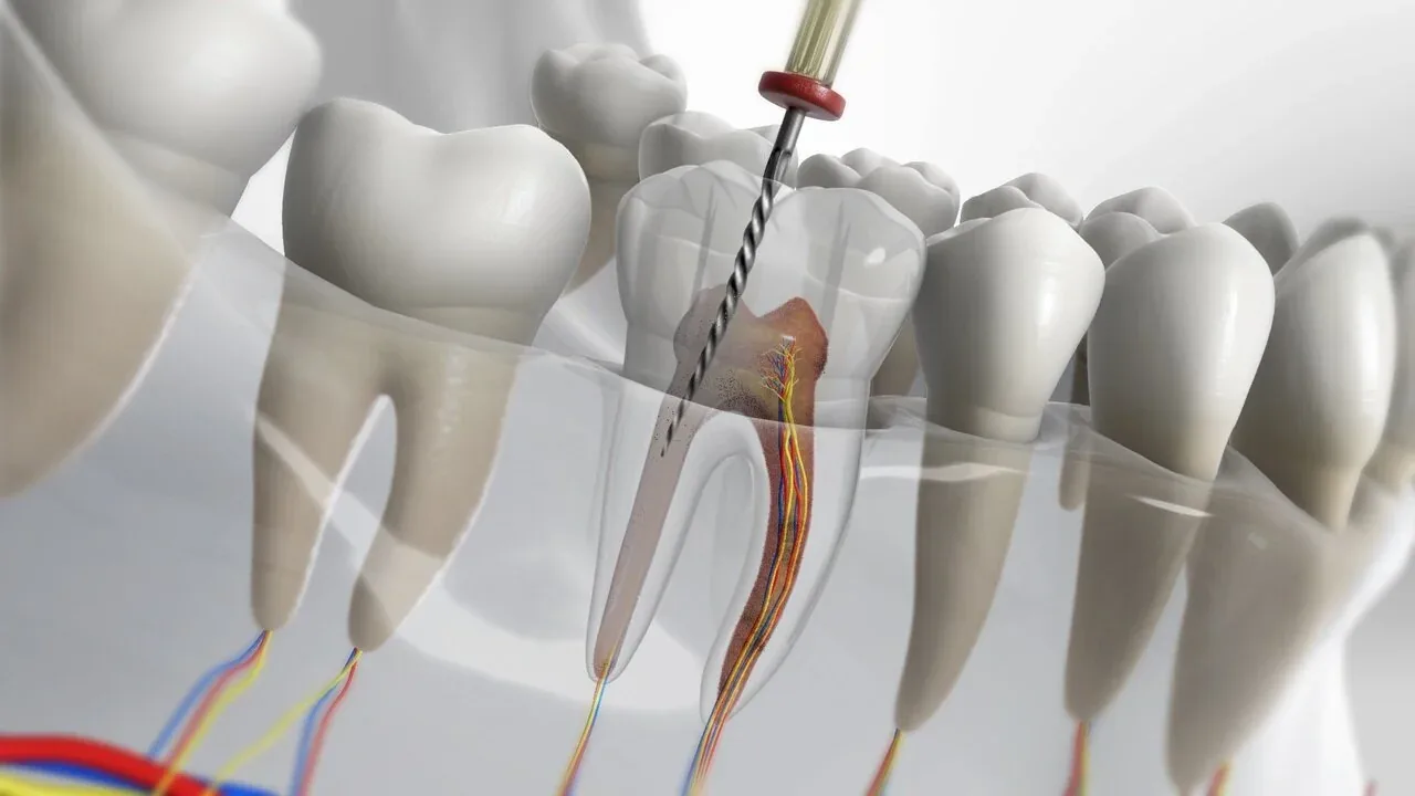 Imagine pentru articolul „Tratamentul endodontic, de la clasic la modern”