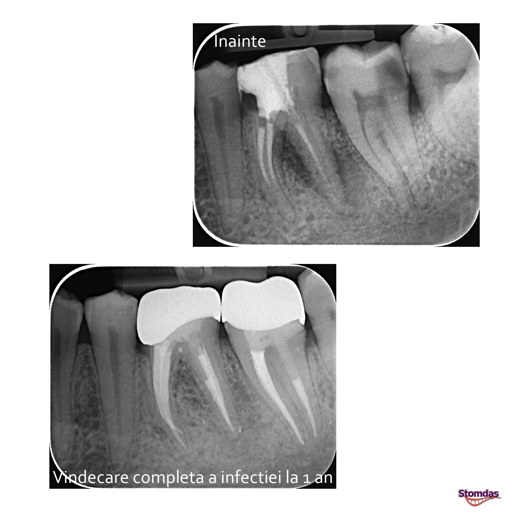 Caz de endodonție tratat la Clinica Stomdas, imaginea 1