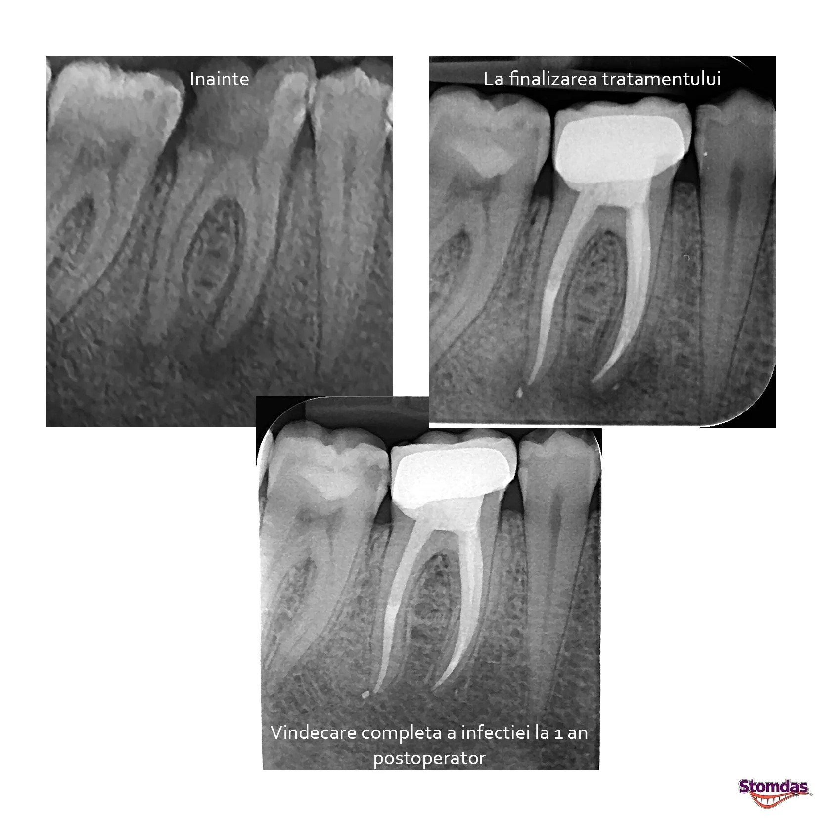 Caz de endodonție tratat la Clinica Stomdas, imaginea 2