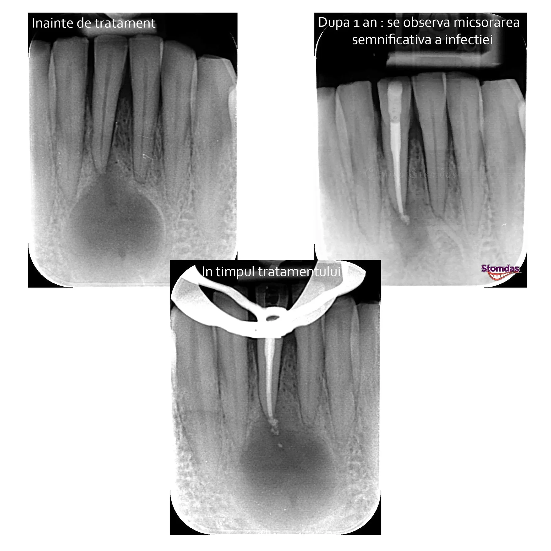 Caz de endodonție tratat la Clinica Stomdas, imaginea 3