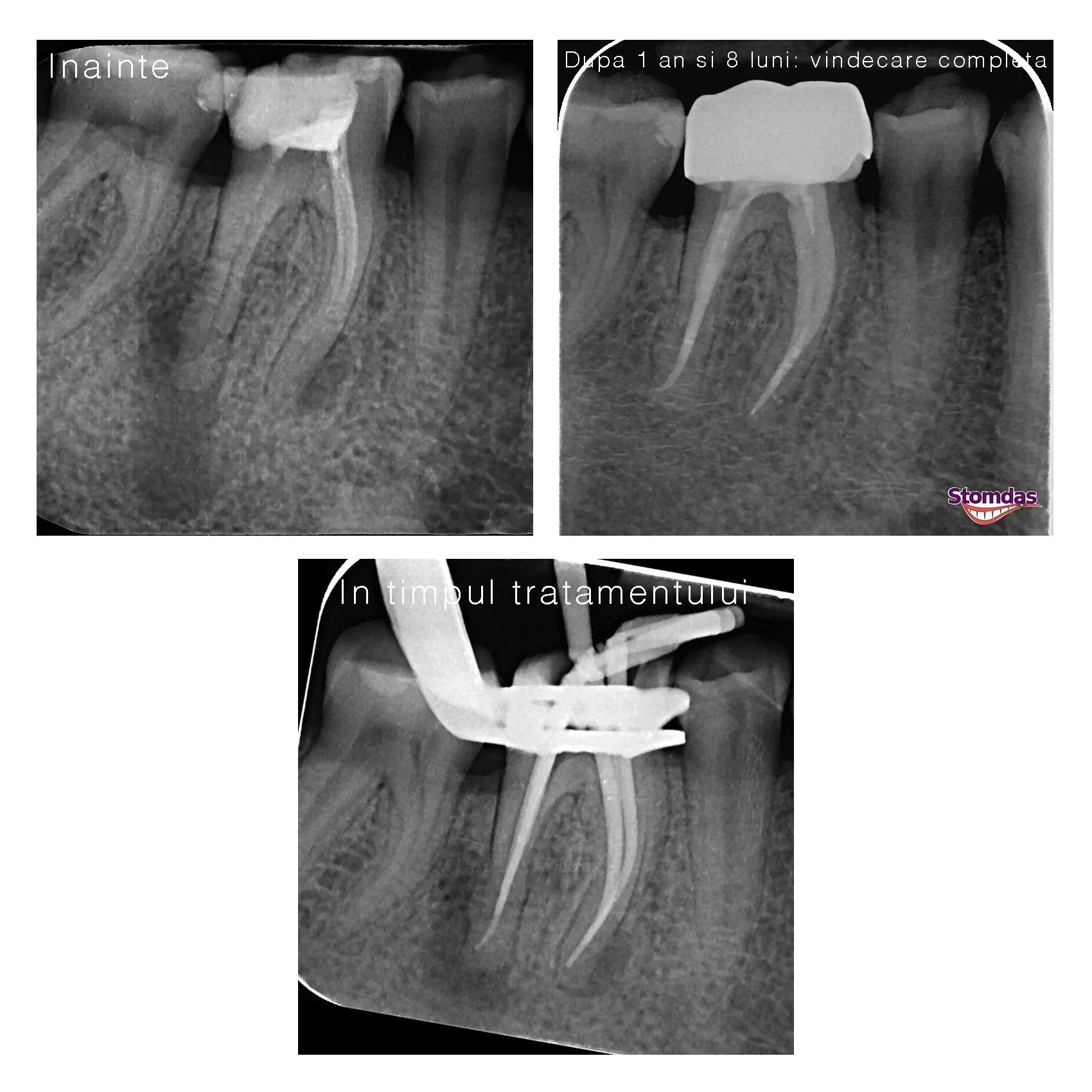 Caz de endodonție tratat la Clinica Stomdas, imaginea 4