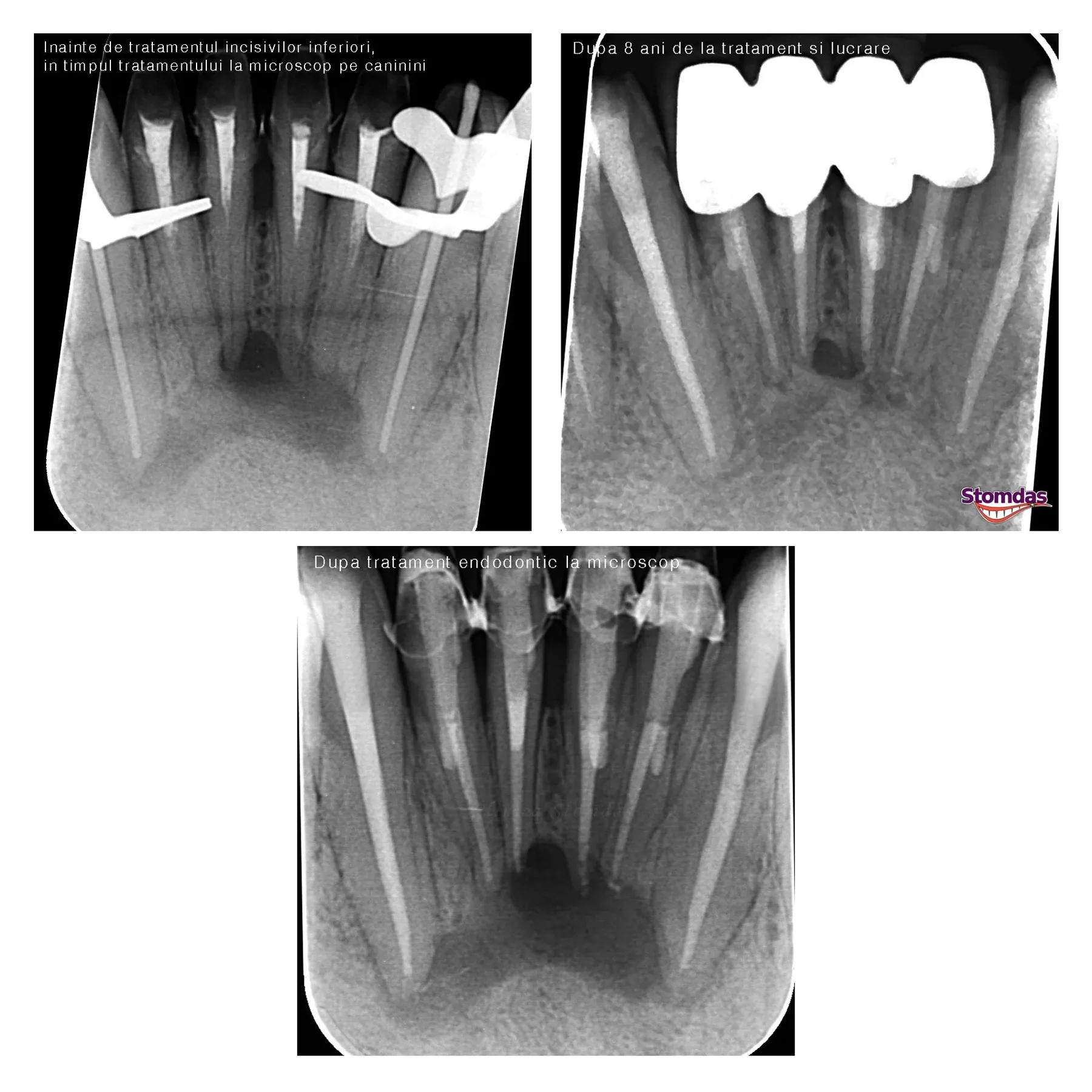 Caz de endodonție tratat la Clinica Stomdas, imaginea 5