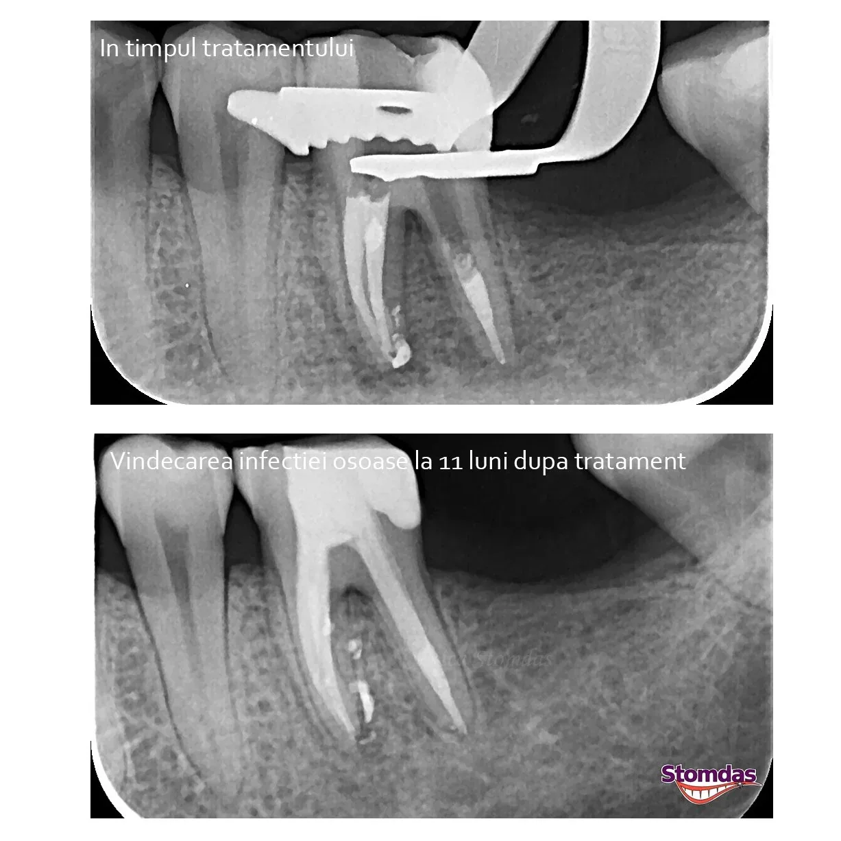Caz de endodonție tratat la Clinica Stomdas, imaginea 6