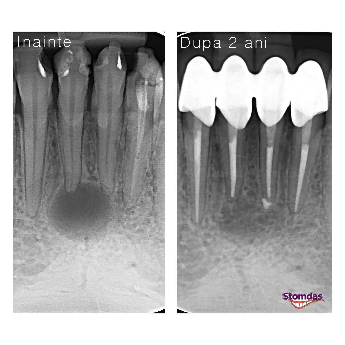 Caz de endodonție tratat la Clinica Stomdas, imaginea 7
