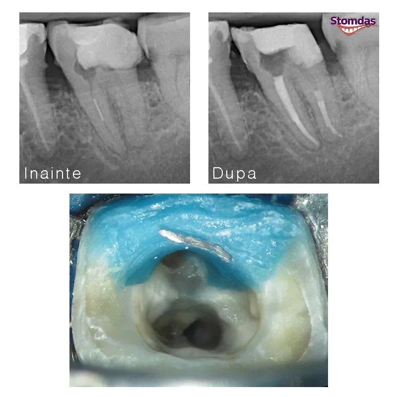 Caz de endodonție tratat la Clinica Stomdas, imaginea 8