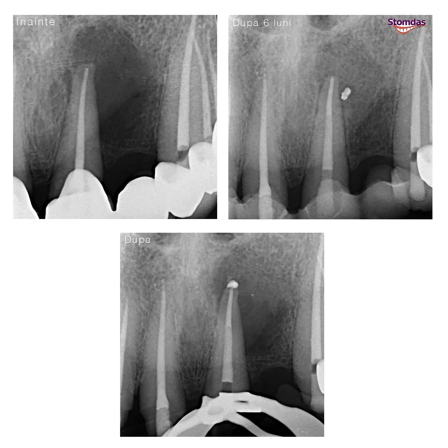 Caz de endodonție tratat la Clinica Stomdas, imaginea 9