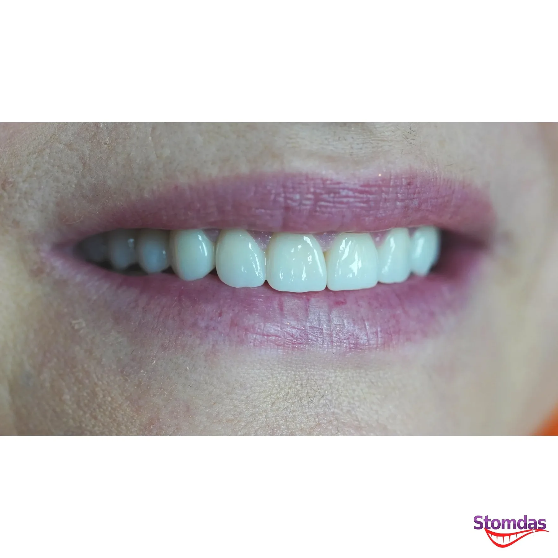 Caz de estetică dentară tratat la Clinica Stomdas, imaginea 1