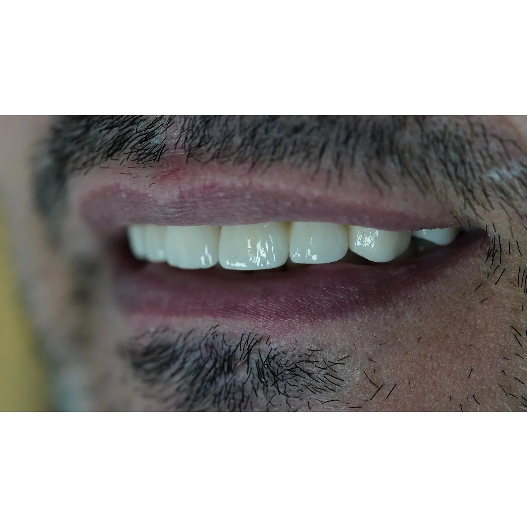 Caz de estetică dentară tratat la Clinica Stomdas, imaginea 2
