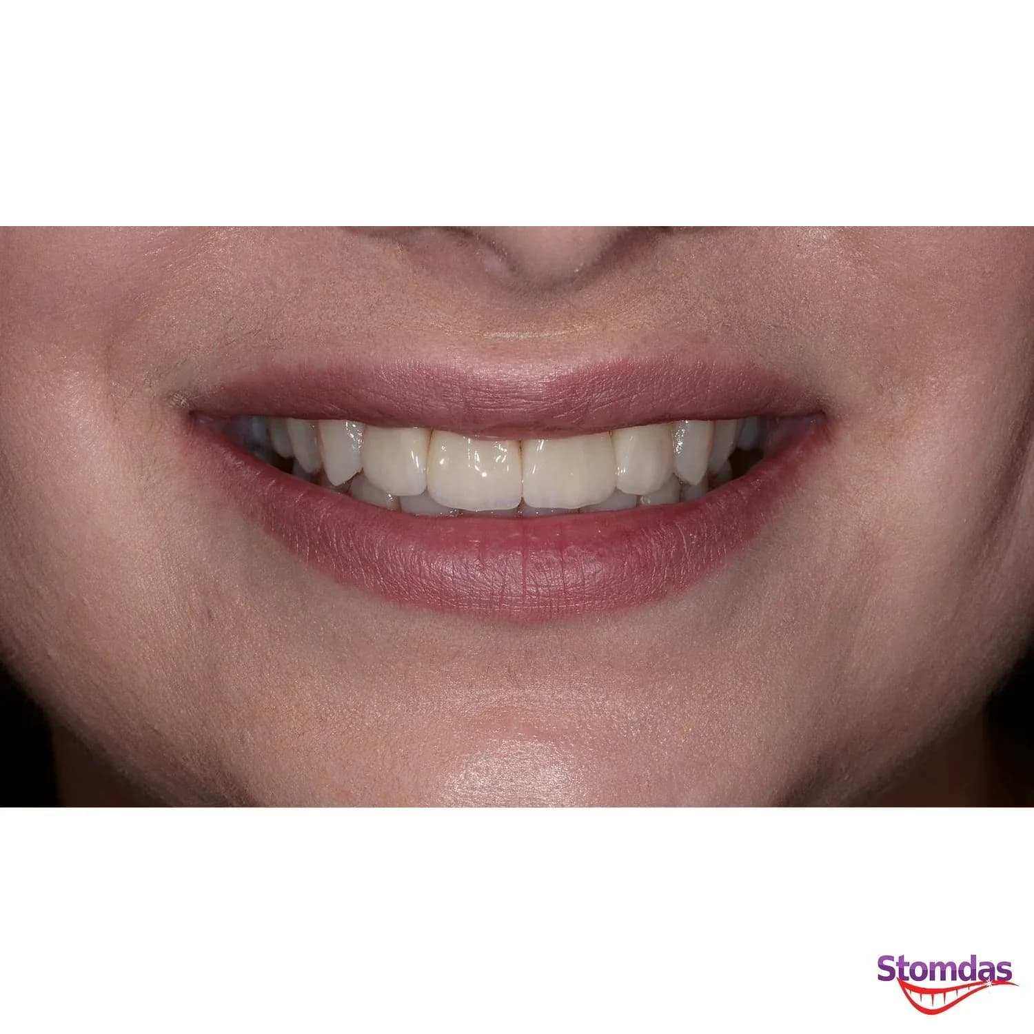 Caz de estetică dentară tratat la Clinica Stomdas, imaginea 4