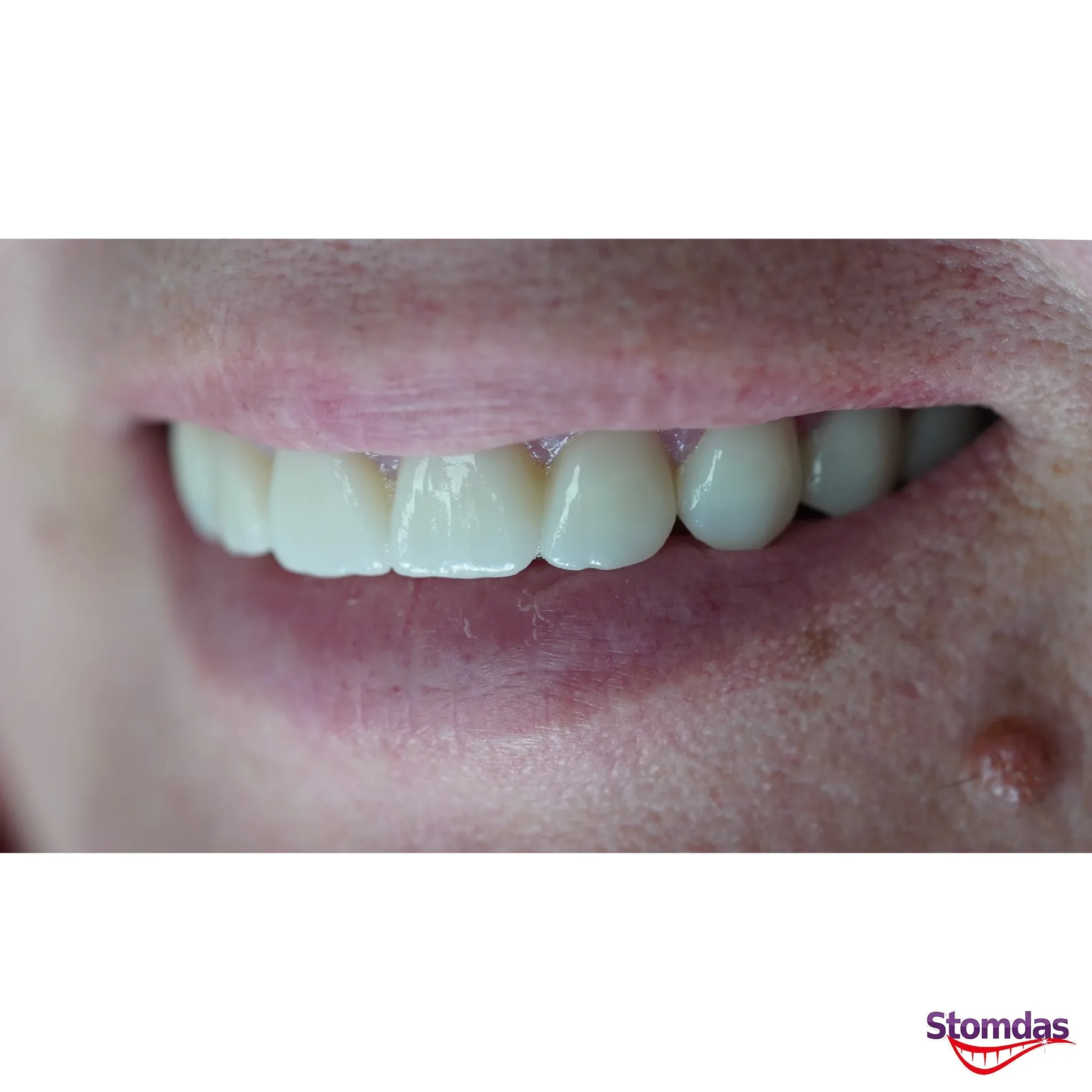 Caz de estetică dentară tratat la Clinica Stomdas, imaginea 5