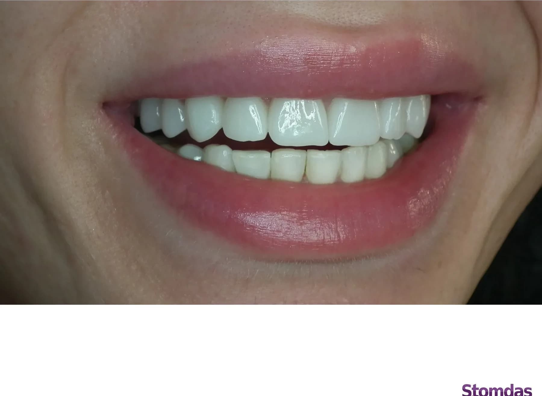 Caz de estetică dentară tratat la Clinica Stomdas, imaginea 6
