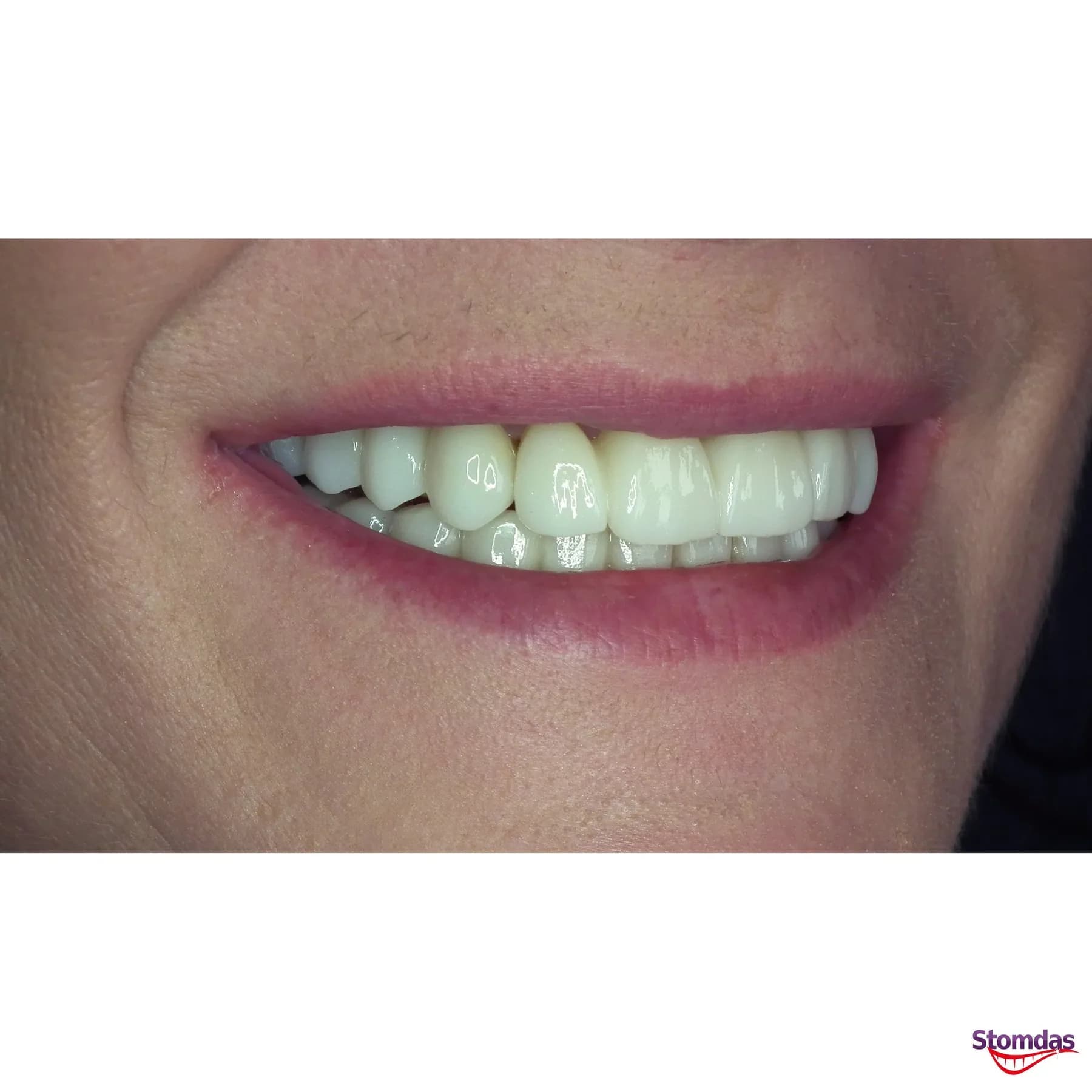 Caz de estetică dentară tratat la Clinica Stomdas, imaginea 7
