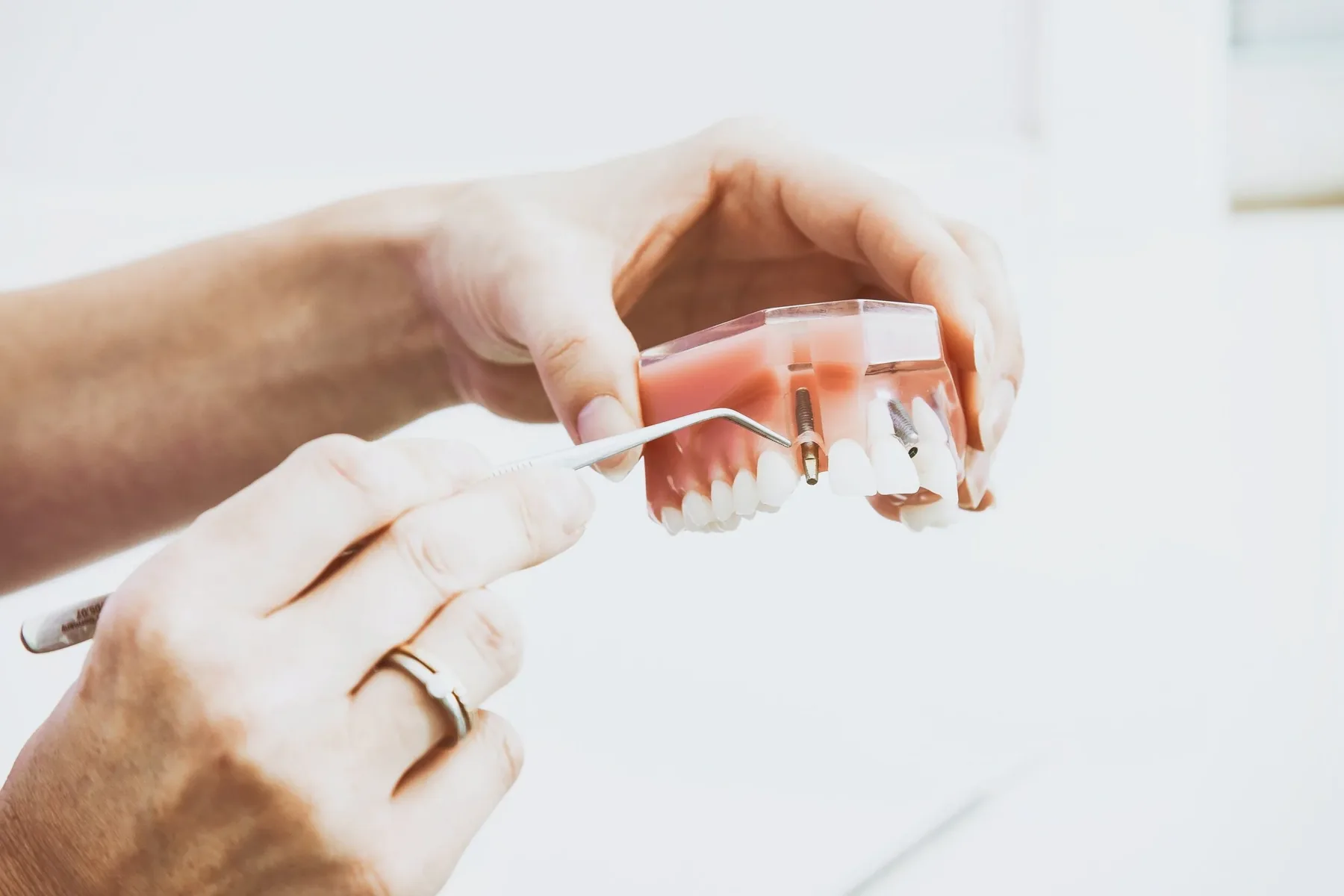 Imagine pentru articolul „4 lucruri mai puțin știute despre implantul dentar”