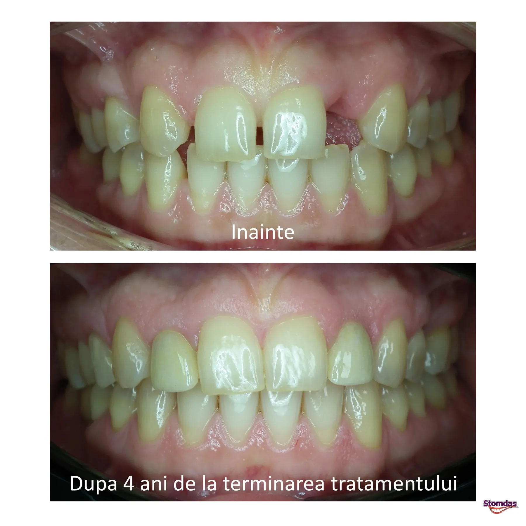 Caz de implantologie tratat la Clinica Stomdas, imaginea 1