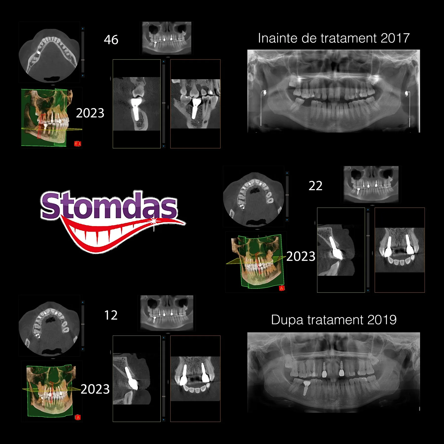 Caz de implantologie tratat la Clinica Stomdas, imaginea 2