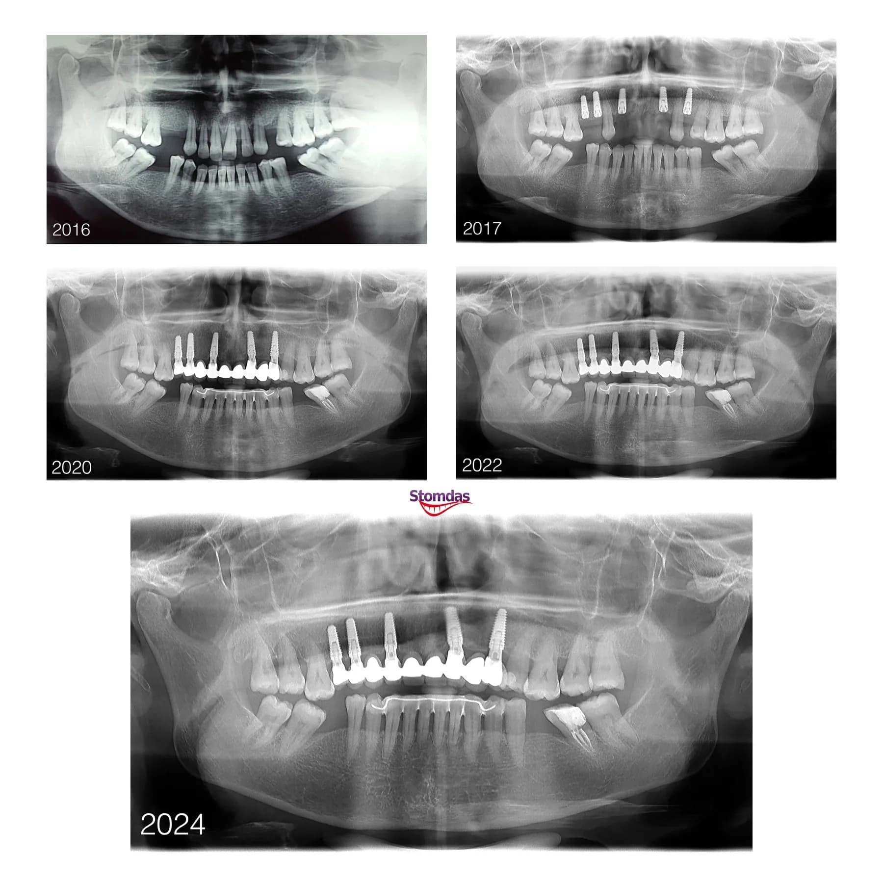 Radiografie panoramică înainte și după reabilitarea unei arcade pe implanturi, la Clinica Stomdas