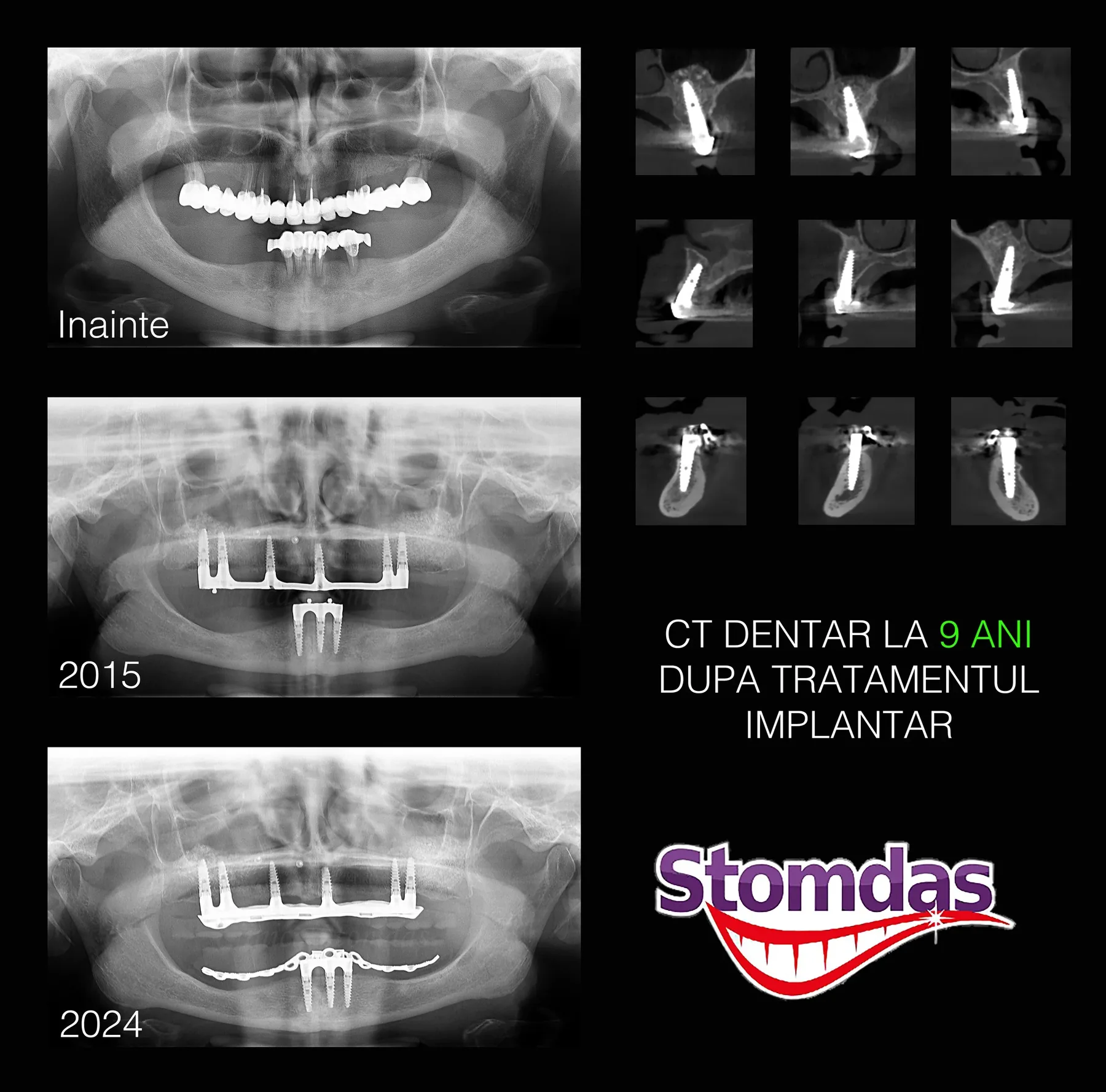 Caz de implantologie tratat la Clinica Stomdas, imaginea 6