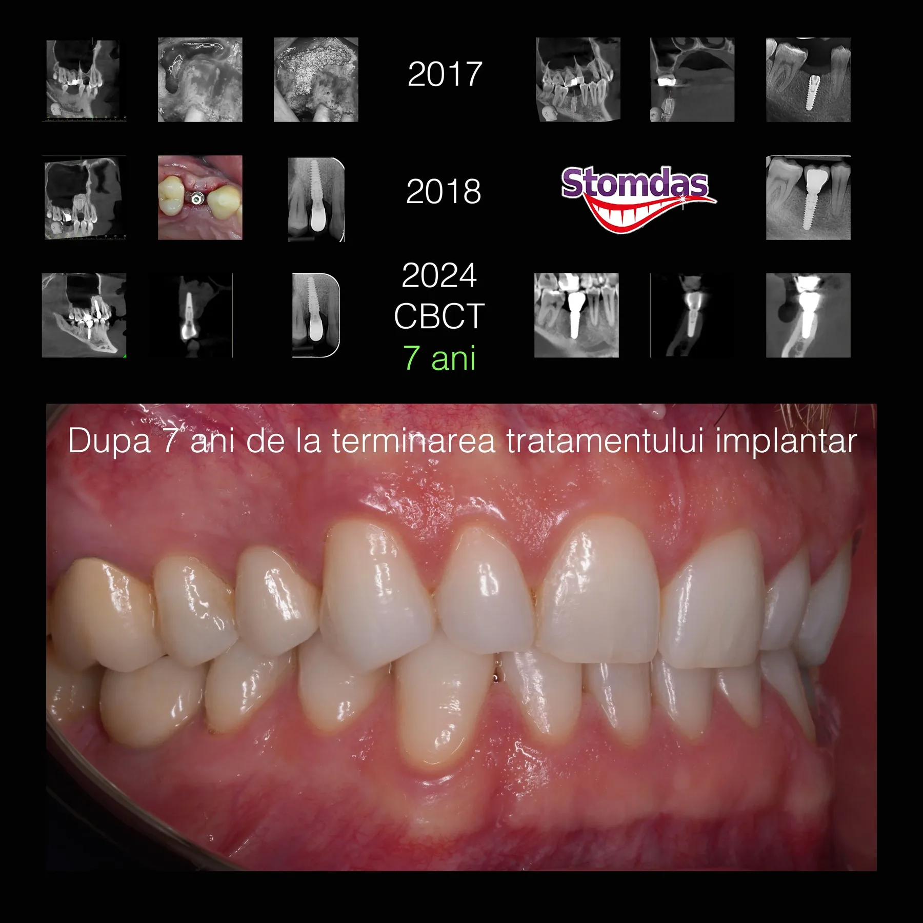 Caz de implantologie tratat la Clinica Stomdas, imaginea 7