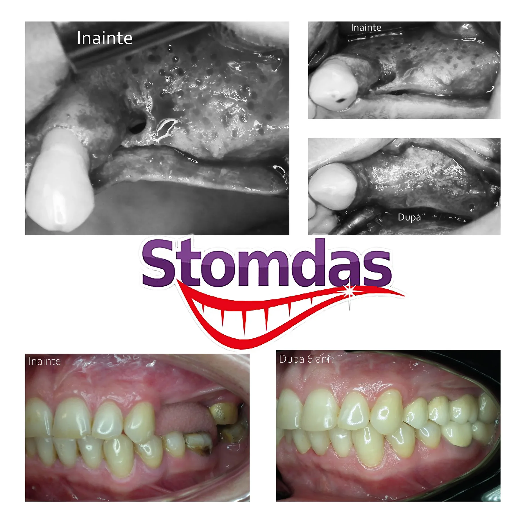 Caz de implantologie tratat la Clinica Stomdas, imaginea 10