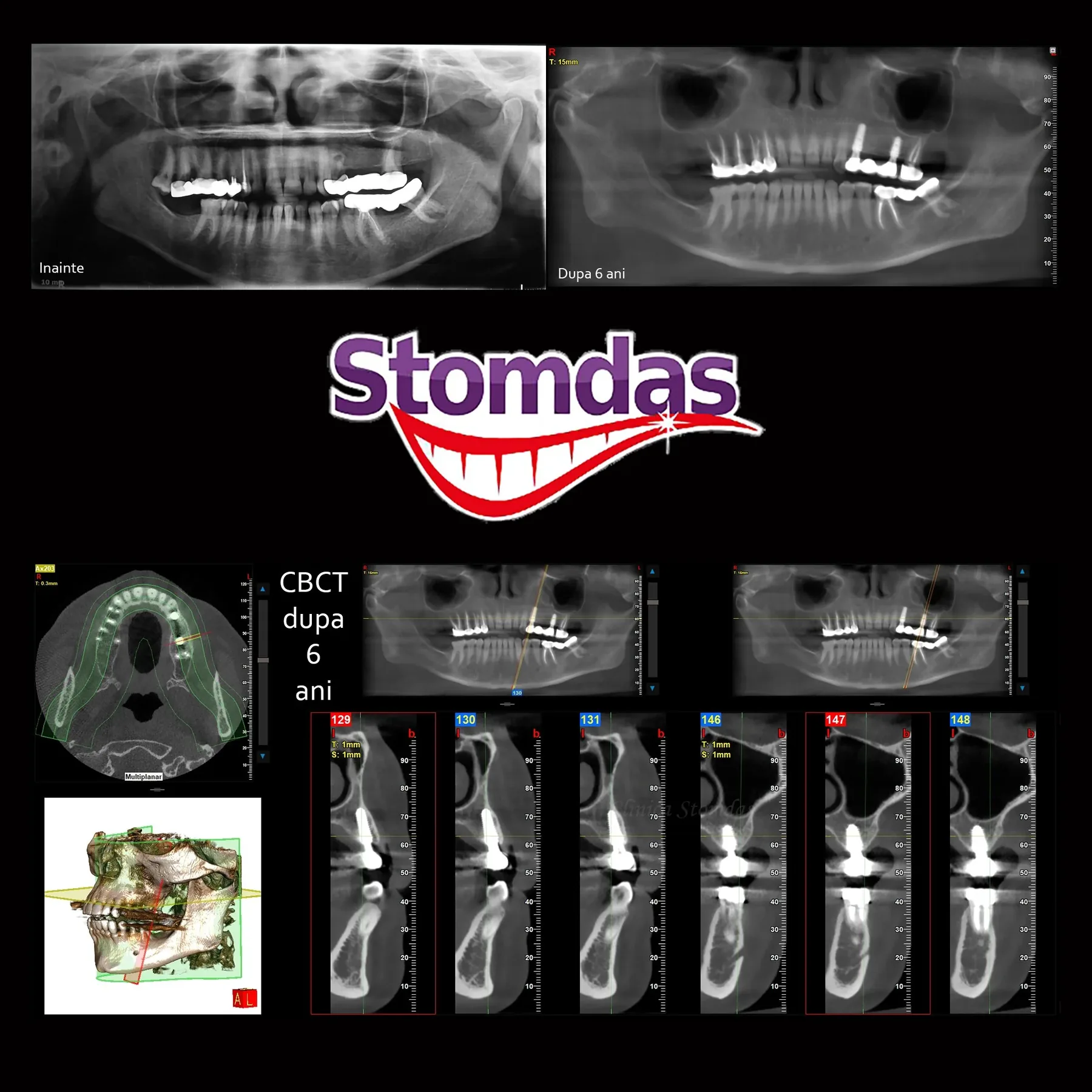 Caz de implantologie tratat la Clinica Stomdas, imaginea 11