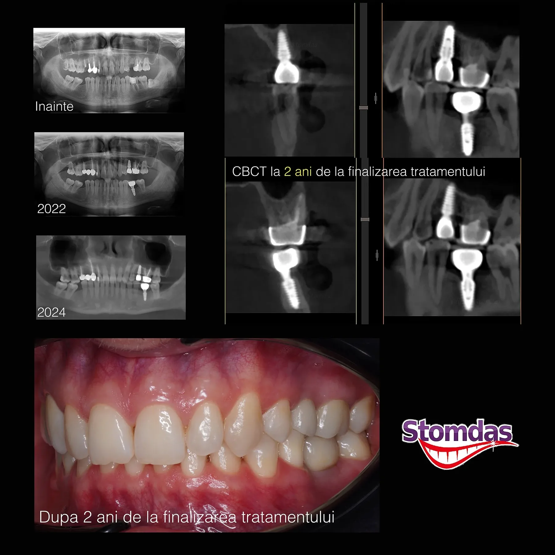 Caz de implantologie tratat la Clinica Stomdas, imaginea 14