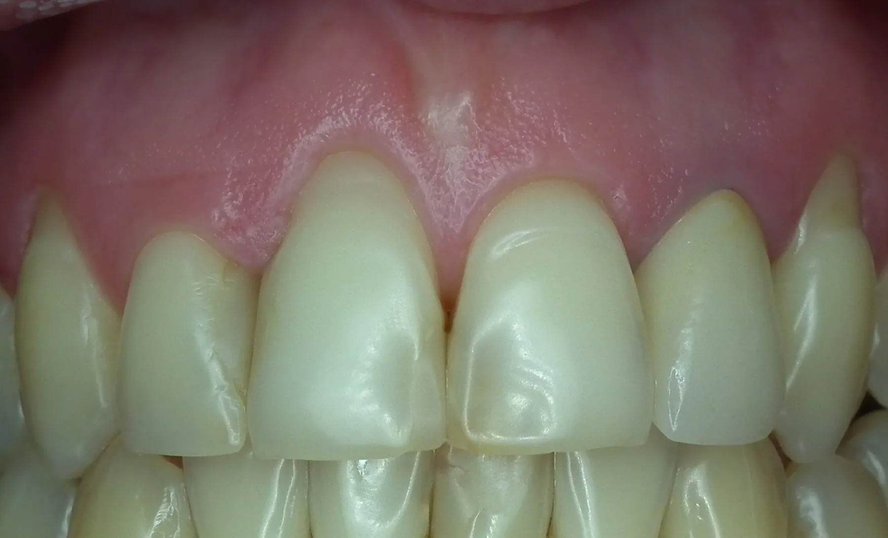 Caz de parodontologie tratat la Clinica Stomdas, imaginea 12