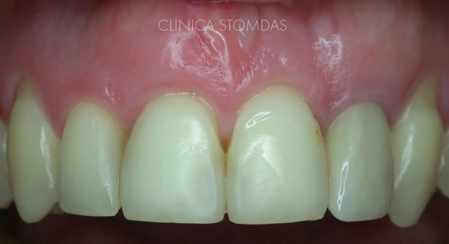 Caz de parodontologie tratat la Clinica Stomdas, imaginea 13