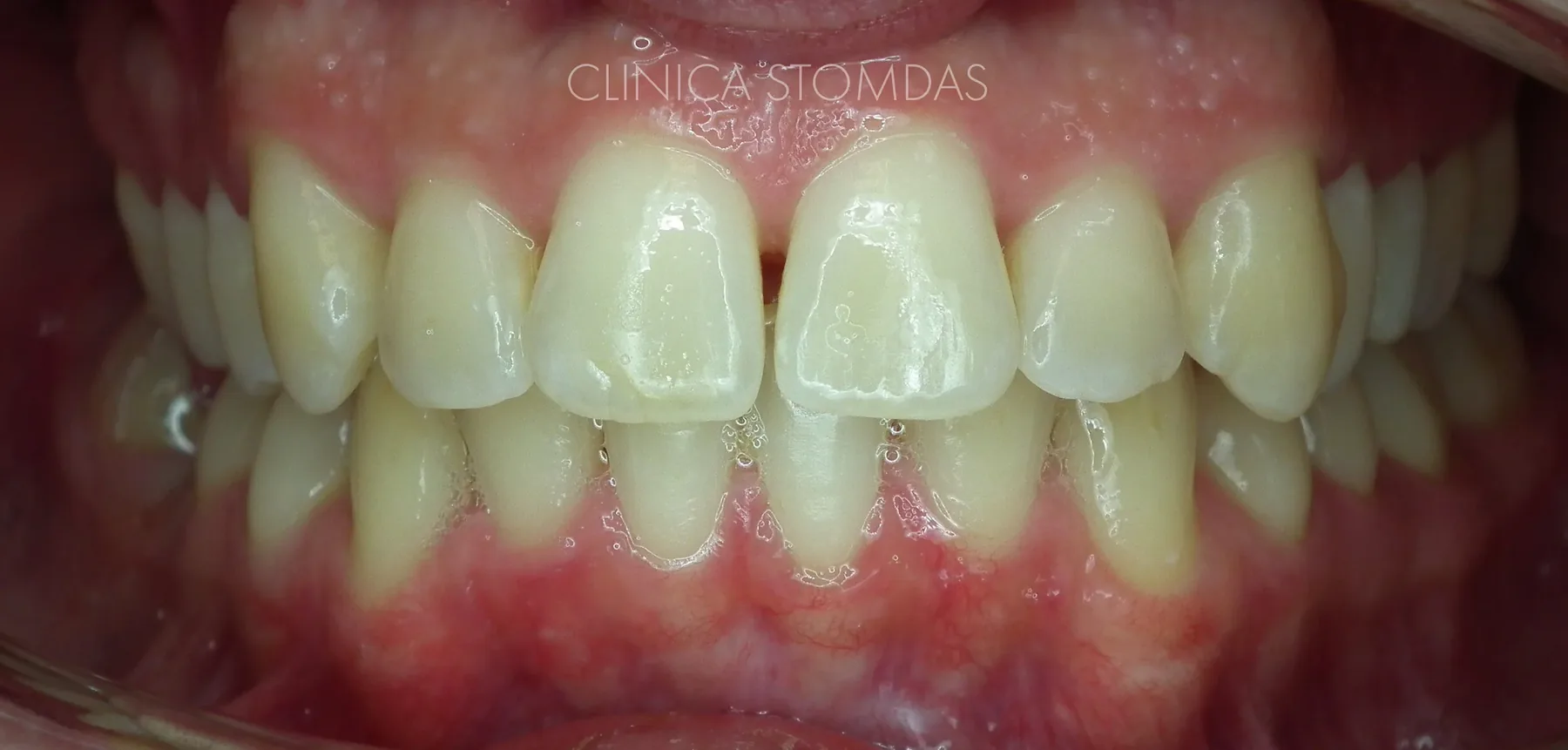 Caz de parodontologie tratat la Clinica Stomdas, imaginea 15