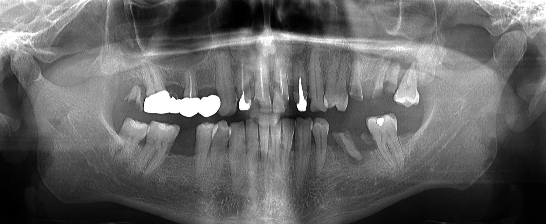 Radiografie panoramică înainte de tratament, 2018