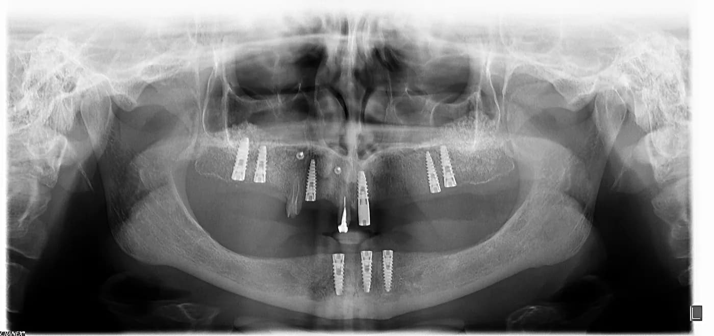 Radiografie panoramică din 2014, la inserarea implanturilor