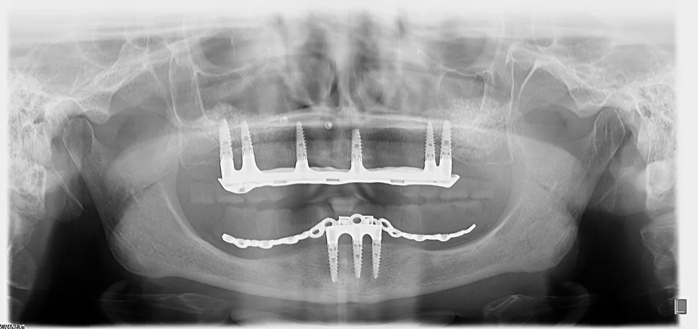 Aceleași implanturi radiografiate în 2026